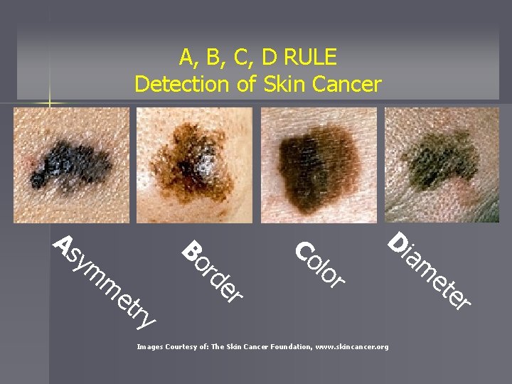 A, B, C, D RULE Detection of Skin Cancer et ry er m rd