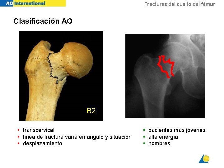 Fracturas del cuello del fémur Clasificación AO B 2 § transcervical § línea de