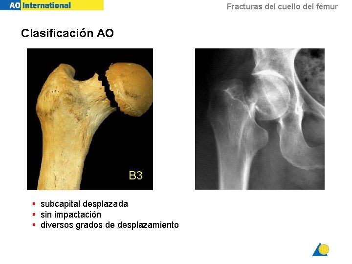 Fracturas del cuello del fémur Clasificación AO B 3 § subcapital desplazada § sin