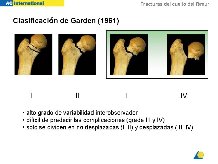 Fracturas del cuello del fémur Clasificación de Garden (1961) I II IV • alto