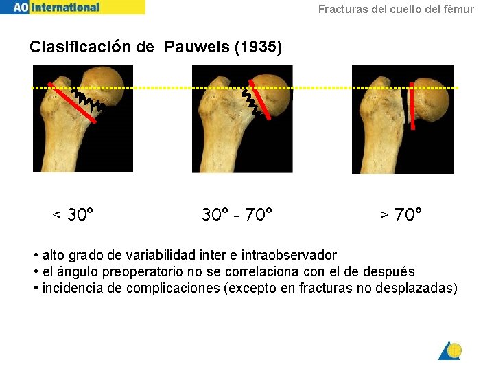 Fracturas del cuello del fémur Clasificación de Pauwels (1935) < 30° - 70° >