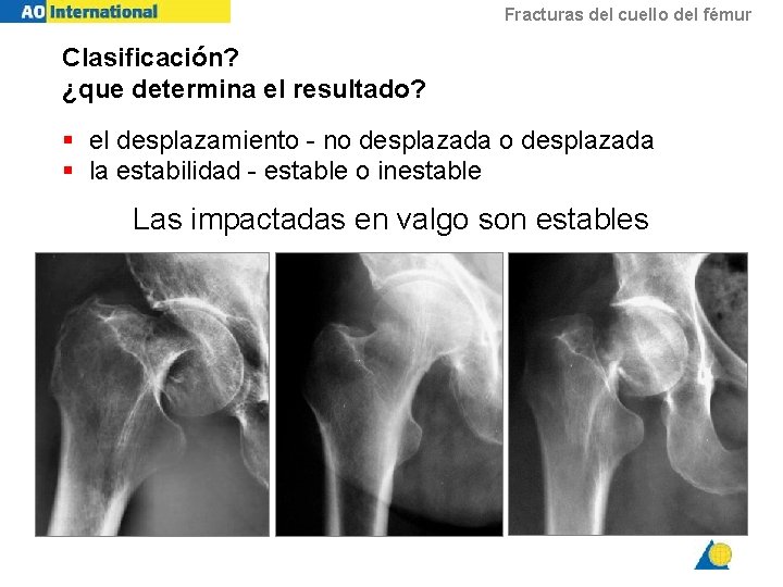 Fracturas del cuello del fémur Clasificación? ¿que determina el resultado? § el desplazamiento -