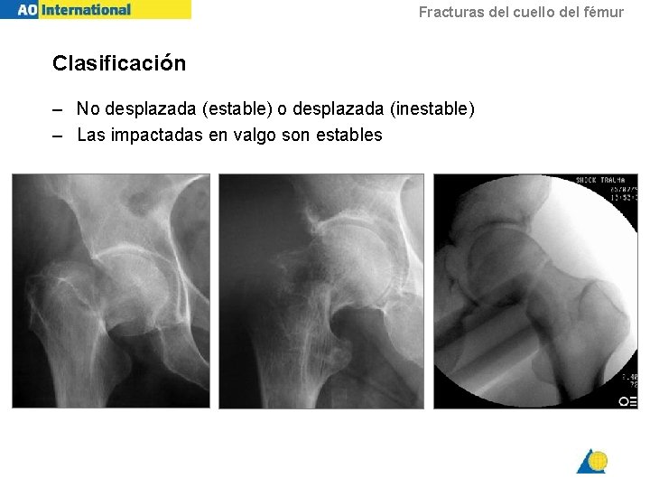 Fracturas del cuello del fémur Clasificación – No desplazada (estable) o desplazada (inestable) –