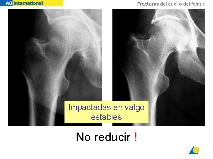 Fracturas del cuello del fémur Impactadas en valgo estables No reducir ! 