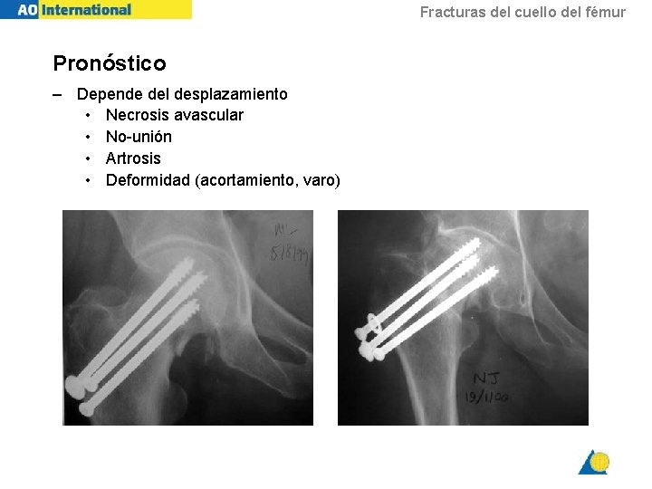 Fracturas del cuello del fémur Pronóstico – Depende del desplazamiento • Necrosis avascular •
