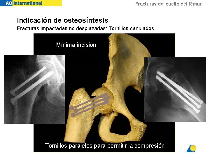 Fracturas del cuello del fémur Indicación de osteosíntesis Fracturas impactadas no desplazadas: Tornillos canulados