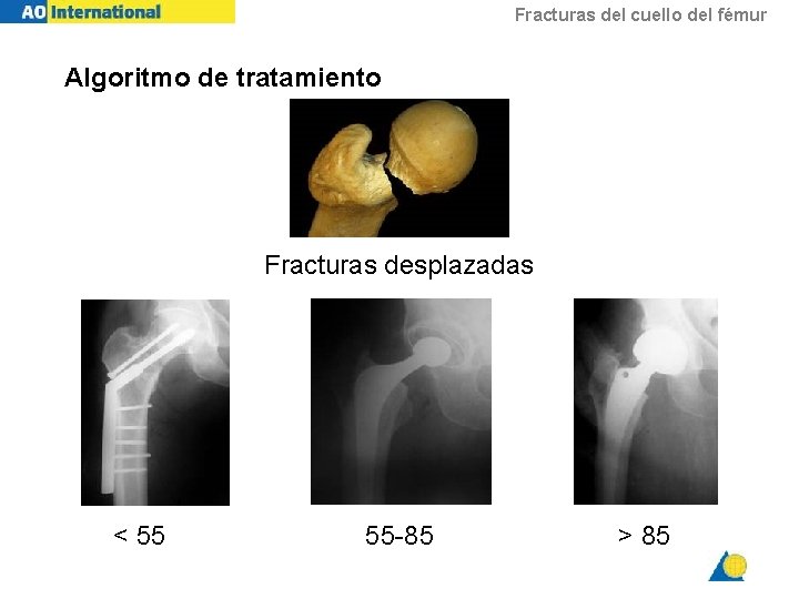 Fracturas del cuello del fémur Algoritmo de tratamiento Fracturas desplazadas < 55 55 -85