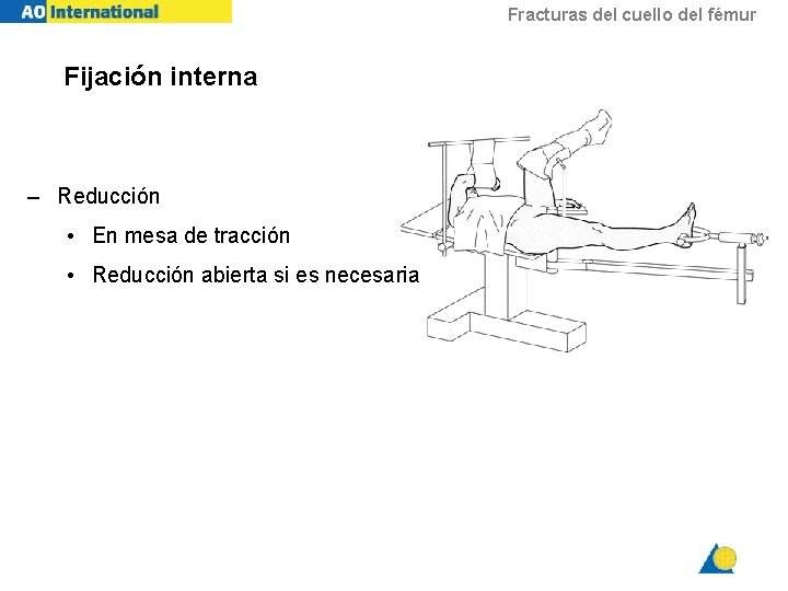 Fracturas del cuello del fémur Fijación interna – Reducción • En mesa de tracción