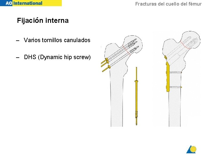 Fracturas del cuello del fémur Fijación interna – Varios tornillos canulados – DHS (Dynamic