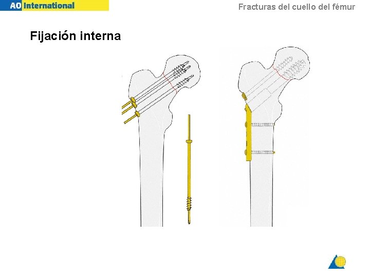 Fracturas del cuello del fémur Fijación interna 