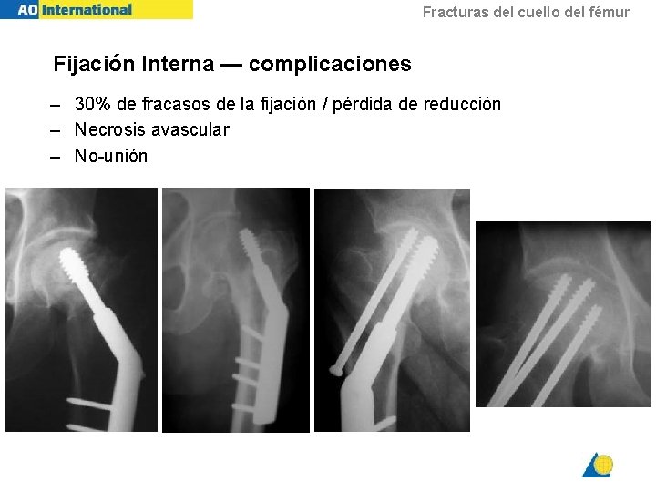 Fracturas del cuello del fémur Fijación Interna — complicaciones – 30% de fracasos de