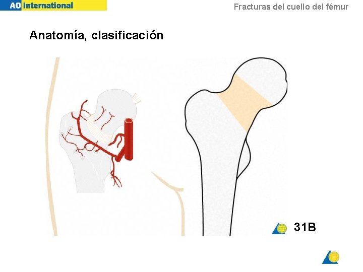 Fracturas del cuello del fémur Anatomía, clasificación 31 B 