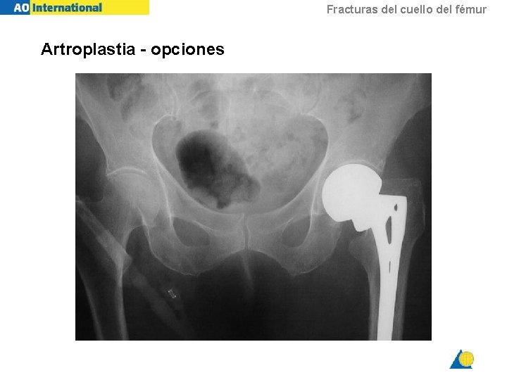 Fracturas del cuello del fémur Artroplastia - opciones 