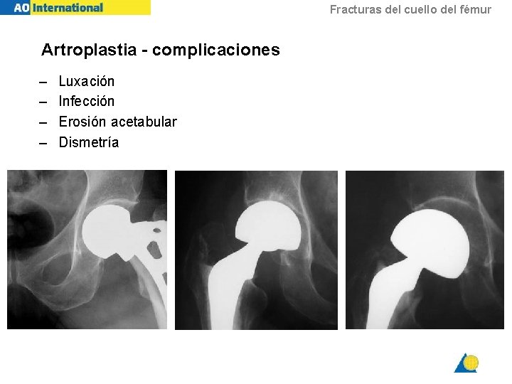 Fracturas del cuello del fémur Artroplastia - complicaciones – – Luxación Infección Erosión acetabular