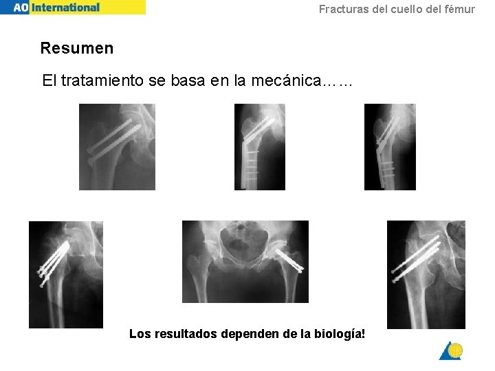 Fracturas del cuello del fémur Resumen El tratamiento se basa en la mecánica…… but