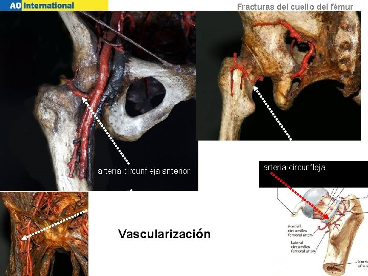 Fracturas del cuello del fémur arteria circunfleja anterior Vascularización arteria circunfleja 