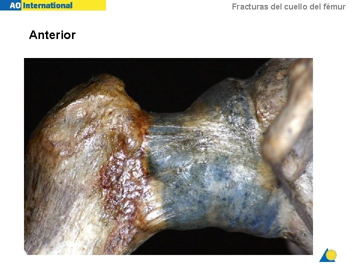 Fracturas del cuello del fémur Anterior 
