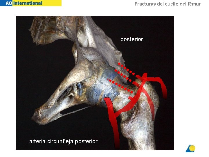 Fracturas del cuello del fémur posterior arteria circunfleja posterior 