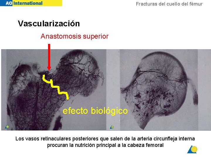 Fracturas del cuello del fémur Vascularización Anastomosis superior efecto biológico Los vasos retinaculares posteriores