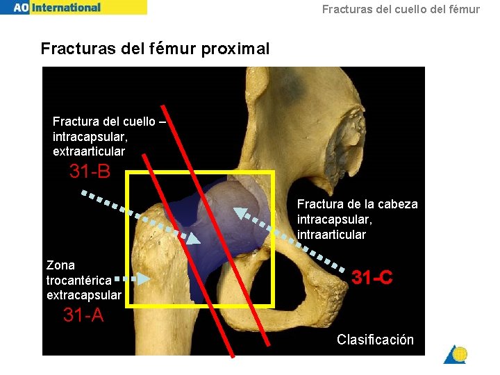 Fracturas del cuello del fémur Fracturas del fémur proximal Fractura del cuello – intracapsular,