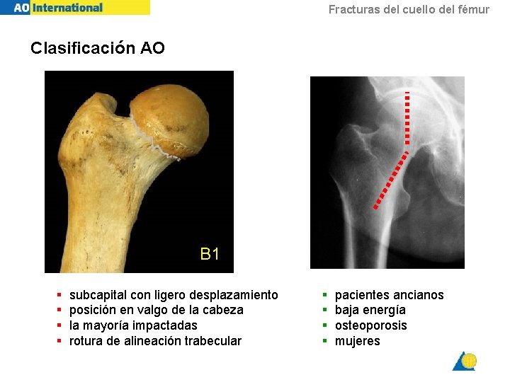 Fracturas del cuello del fémur Clasificación AO B 1 § § subcapital con ligero