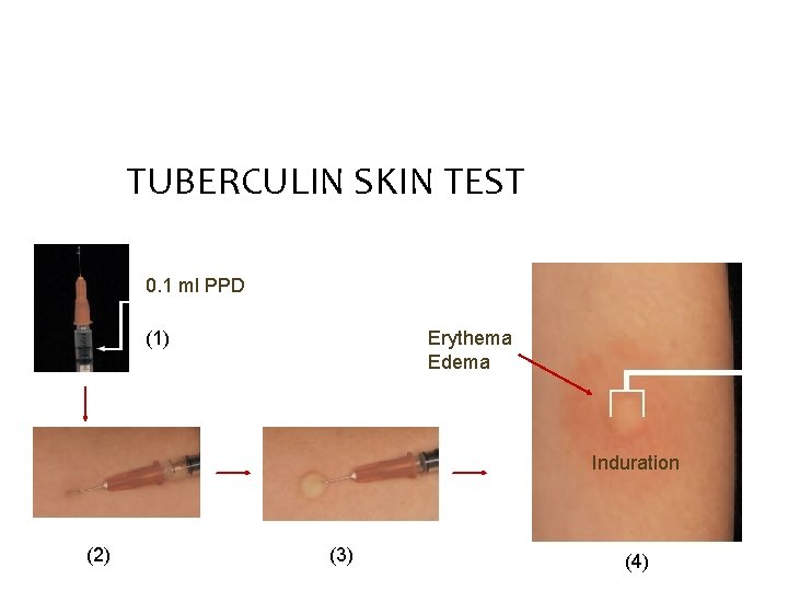 TUBERCULIN SKIN TEST 0. 1 ml PPD (1) Erythema Edema Induration (2) (3) (4)