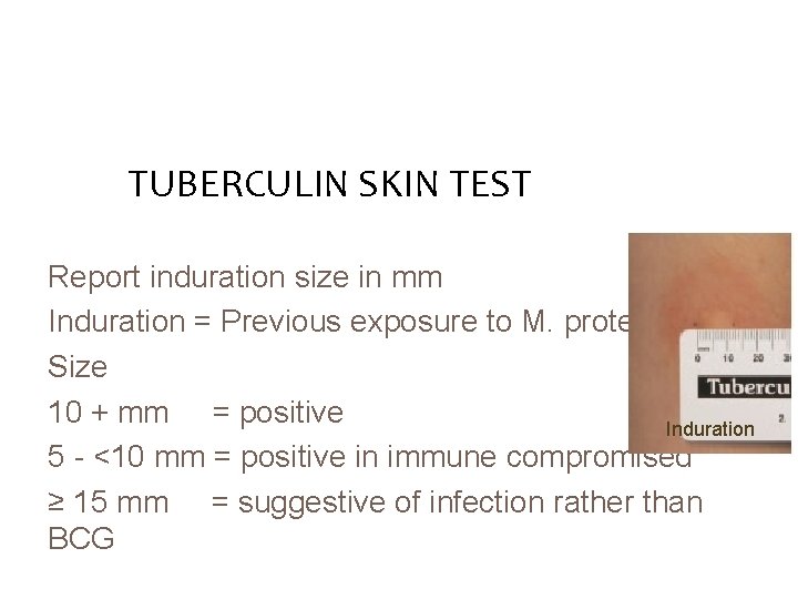 TUBERCULIN SKIN TEST Report induration size in mm Induration = Previous exposure to M.