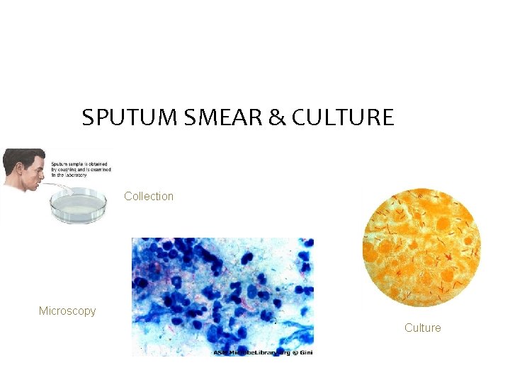 SPUTUM SMEAR & CULTURE Collection Microscopy Culture 