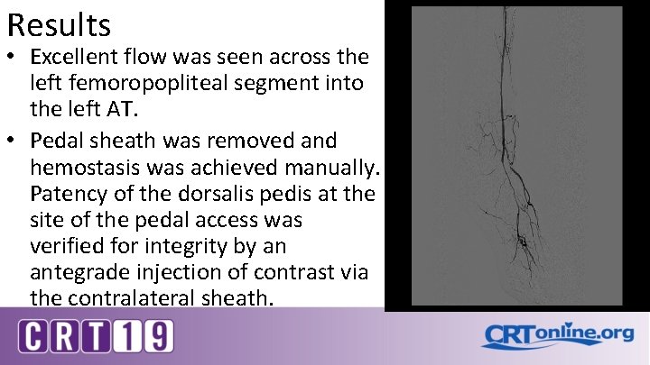 Results • Excellent flow was seen across the left femoropopliteal segment into the left