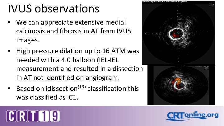 IVUS observations • We can appreciate extensive medial calcinosis and fibrosis in AT from