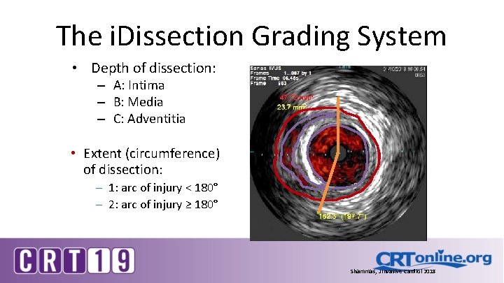 The i. Dissection Grading System • Depth of dissection: – A: Intima – B: