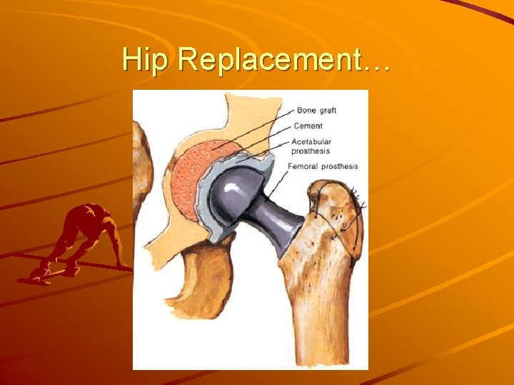 Hip Replacement… 