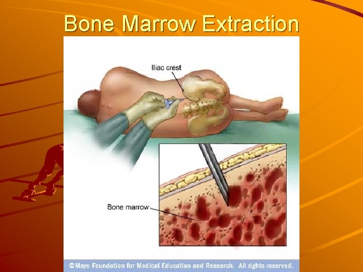 Bone Marrow Extraction 