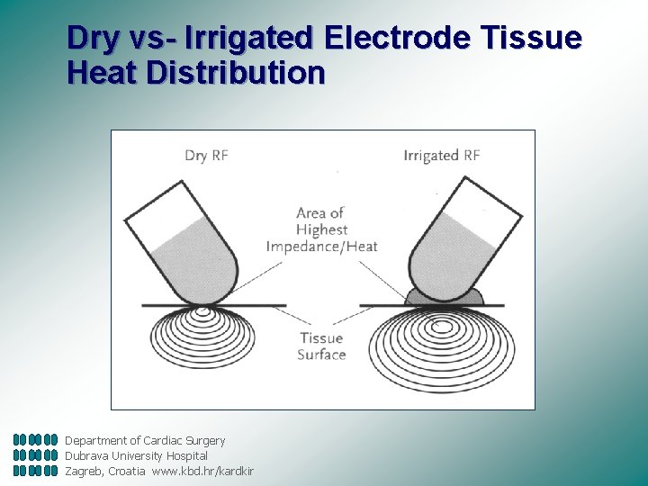 Dry vs- Irrigated Electrode Tissue Heat Distribution Department of Cardiac Surgery Dubrava University Hospital