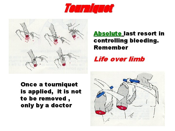 Tourniquet Absolute last resort in controlling bleeding. Remember Life over limb Once a tourniquet