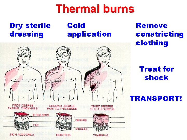 Thermal burns Dry sterile dressing Cold application Remove constricting clothing Treat for shock TRANSPORT!