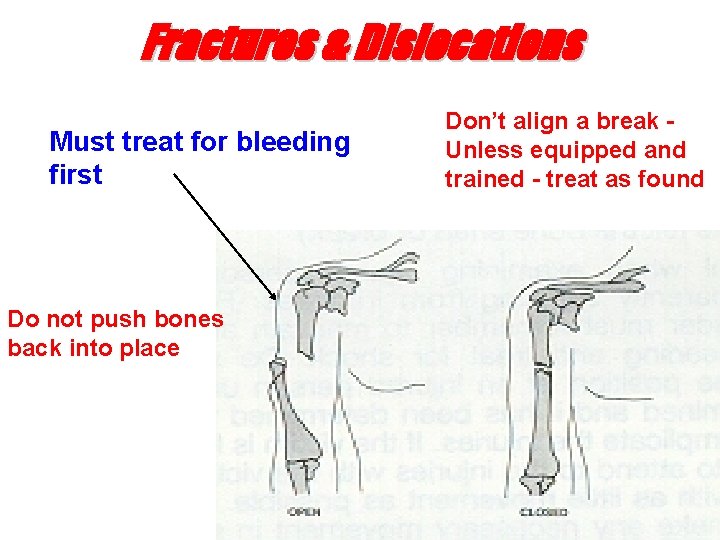 Fractures & Dislocations Must treat for bleeding first Do not push bones back into