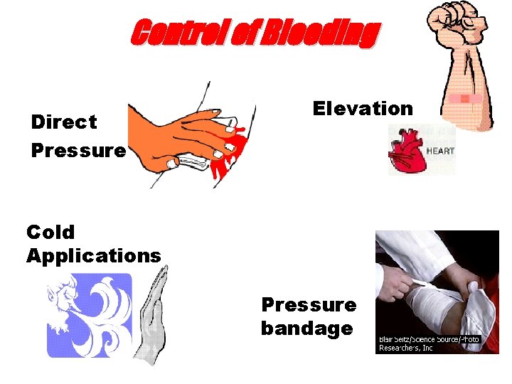 Control of Bleeding Direct Pressure Elevation Cold Applications Pressure bandage 