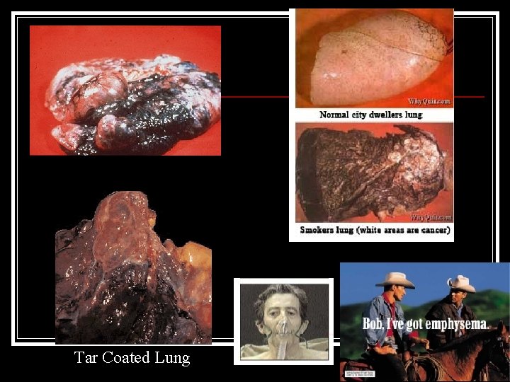 Tar Coated Lung 