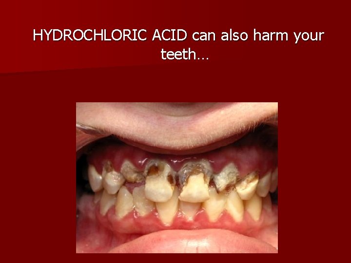 HYDROCHLORIC ACID can also harm your teeth… 