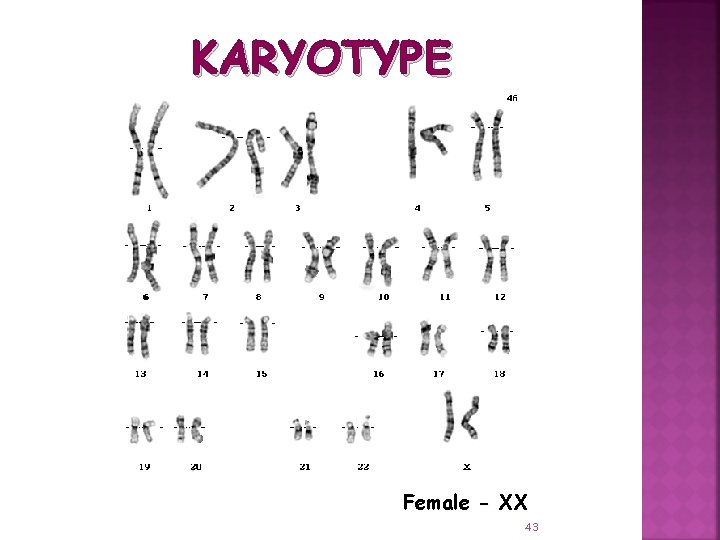 KARYOTYPE Female - XX 43 