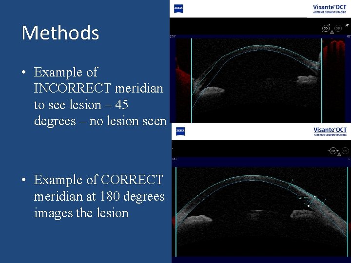 Methods • Example of INCORRECT meridian to see lesion – 45 degrees – no