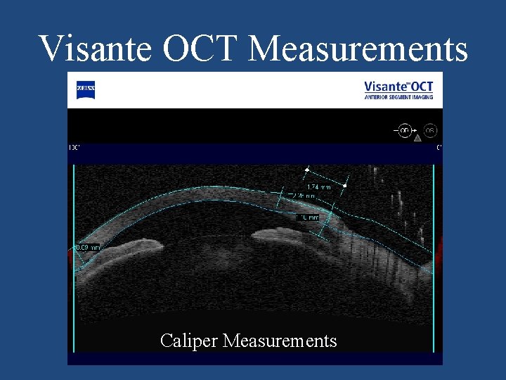 Visante OCT Measurements Caliper Measurements 