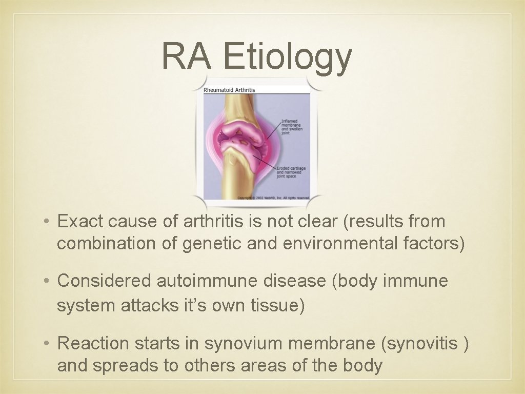 RA Etiology • Exact cause of arthritis is not clear (results from combination of