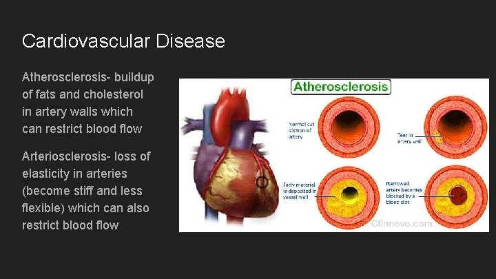 Cardiovascular Disease Atherosclerosis- buildup of fats and cholesterol in artery walls which can restrict