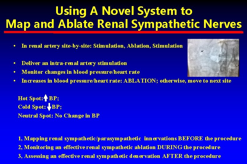 Using A Novel System to Map and Ablate Renal Sympathetic Nerves • In renal Using A Novel System to Map and Ablate Renal Sympathetic Nerves • In renal