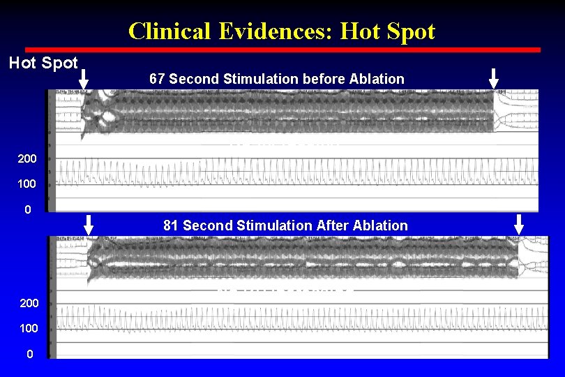 Clinical Evidences: Hot Spot 200 67 Second Stimulation before Ablation BP Increasing 100 0 Clinical Evidences: Hot Spot 200 67 Second Stimulation before Ablation BP Increasing 100 0