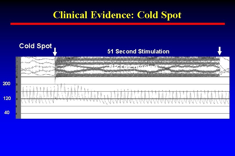 Clinical Evidence: Cold Spot 51 Second Stimulation BP Decreasing 200 120 40 Clinical Evidence: Cold Spot 51 Second Stimulation BP Decreasing 200 120 40