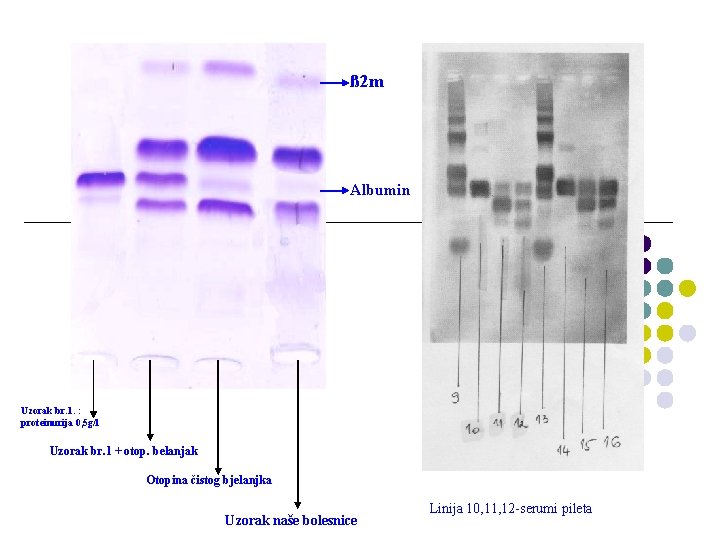 ß 2 m Albumin Uzorak br. 1. : proteinurija 0, 5 g/l Uzorak br.