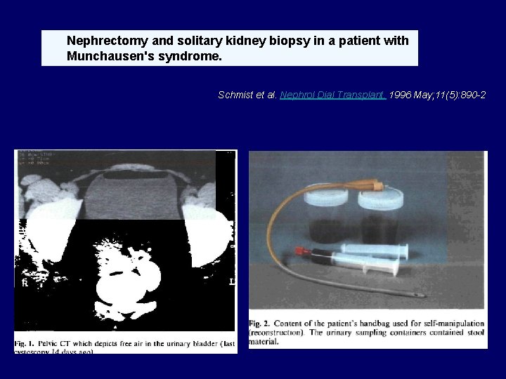 Nephrectomy and solitary kidney biopsy in a patient with Munchausen's syndrome. Schmist et al.